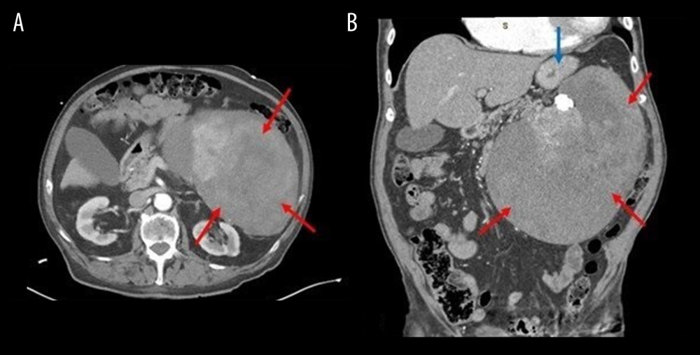 Abdominal CT scan of the benign solitary fibrous tumor. Axial scan (A) and coronal scan (B) demonstrate a 19.7×20.2×14.7 cm large complex mass (red arrows) in the left upper quadrant of the abdomen containing calcifications and hypodensities that does not seem to be arising from the stomach, spleen (blue arrow), pancreas, adrenal, or left kidney.