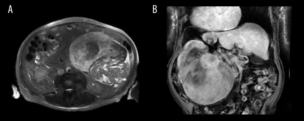 An axial T2 MRI demonstrating left-sided giant abdominal soft-tissue tumor (A). A coronal gradient echo MRI images demonstrating large left-sided abdominal soft-tissue tumor (B).