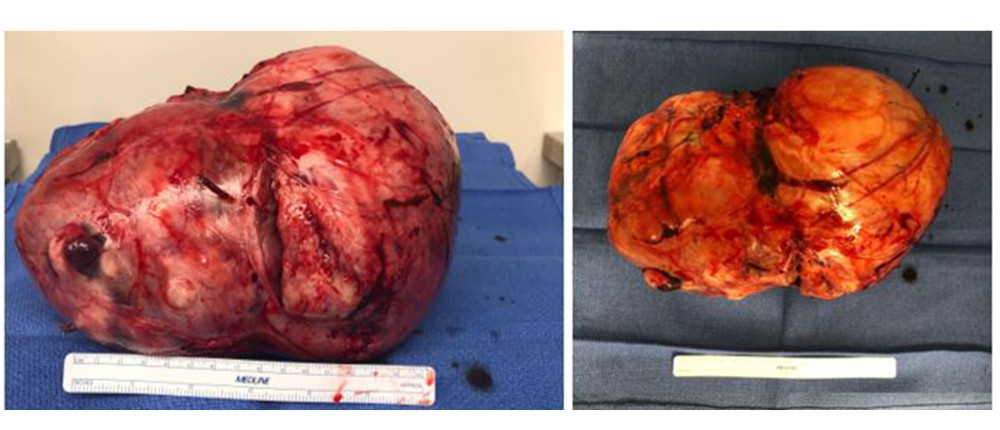Gross examination of the abdominal mass resection demonstrated a 2860 g, 20×16.3×15 cm, well-circumscribed, unencapsulated mass. Sectioning showed a pale tan-to-yellow, whirled, lobulated appearance with areas of cystic degeneration and hemorrhage. Microscopic examination showed a characteristic patternless pattern of spindle cells with alternating hyper- and hypocellular areas, dense collagenous bands, staghorn vessels, and focal (<10%) tumor necrosis, consistent with a solitary fibrous tumor.