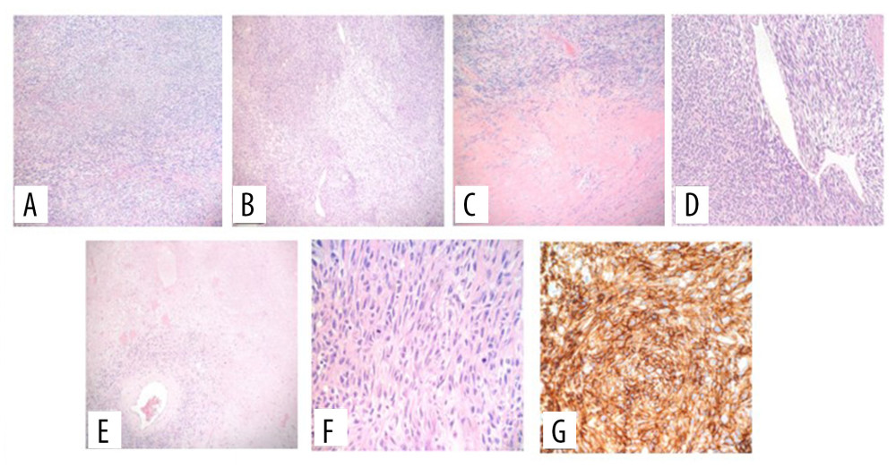 Microscopic examination showed a characteristic patternless pattern of spindle cells (A) with alternating hyper- and hypocellular areas (B), dense collagenous bands (C), staghorn vessels (D), and focal (<10%) tumor necrosis (E). On higher magnification (F), the cells exhibited bland, uniform, elongated nuclei with indistinct nucleoli, minimal atypia, and occasional (>4/10 HPF) mitotic figures. Immunohistochemical stains showed the tumor cells to be positive for CD34 (G), STAT6, TLE1, Desmin, AE1/AE3 (focal), CAM5.2 (focal), Beta-catenin and BCL-2, and negative for CD117, S100, Melan-A, SOX10, and ER. Ki-67 was positive in less than 1% of cells.