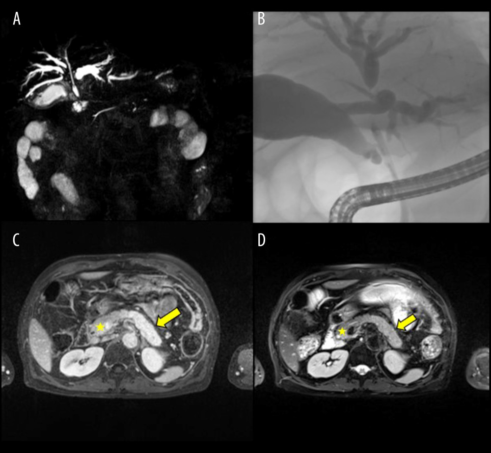 Magnetic resonance imaging (MRI), magnetic resonance cholangiopancreatography (MRCP), and endoscopic retrograde cholangiopancreatography (ERCP) on admission (before treatment). (A) MRI and MRCP with contrast medium before treatment show multifocal strictures, partly dilated intrahepatic biliary tracts, and a central T2-signal-sparing lesion in the common bile duct (CBD). Those findings are usually indistinguishable from those of primary sclerosing cholangitis or hilar cholangiocarcinoma. There were no intrahepatic or pancreatic masses that could have caused an obstructive jaundice. In the contrast-enhanced, T1-weighted studies, no signs of pathological signal alterations were detectable in the pancreatic head. (B) ERCP on admission shows signs of intrahepatic and extrahepatic biliary tree dilatation and a subhepatic contrast medium-sparing lesion in the CBD. (C) Axial T1-weighted, contrast-enhanced MRI in a more delayed phase demonstrates a delayed enhancement of the pancreatic tail (arrow) compared to the pancreatic head (star). This is a characteristic feature of autoimmune pancreatitis. (D) Axial T2-weighted imaging reveals a slight but diffuse enlargement of the pancreatic tail and loss of normal fatty lobulation of the organ, along with a slim, hypointense halo around the pancreatic tail (arrow) compared to the head (star). The main pancreatic duct is tender and not dilated.