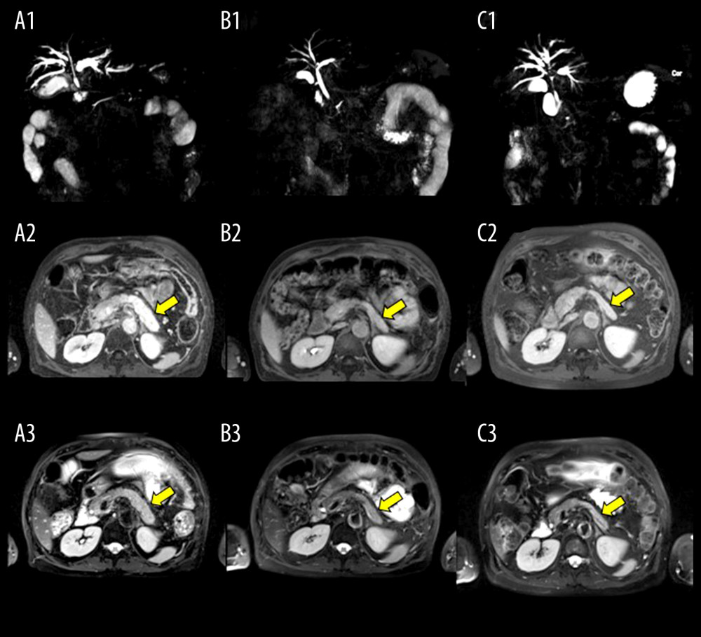 Magnetic resonance cholangiopancreatography (MRCP) and magnetic resonance imaging (MRI) studies at different times during treatment of immunoglobulin G4-related disease. (A1–A3: on admission, B1–B3: after 6 weeks, C1–C3: after 5 months of treatment). A1 MRCP shows initial intrahepatic and extrahepatic biliary tree dilatation on admission (before treatment) (also see Figure 1A). B1 After 6 weeks of the steroid therapy, MRI reveals total resolution of the subhepatic common bile duct (CBD) stenosis. C1 shows a progressive CBD stenosis with dilated intrahepatic bile ducts after short discontinuation of prednisolone, about 5 months after the start of treatment. A2, B2, C2 (axial T1-weighted) and A3, B3, C3 (axial T2-weighted): In the follow-up examinations after 6 weeks (B2, B3) and 5 months later after steroid therapy (C2, C3), the pancreas appears normal-size, with resolution of the previously seen low-attenuation halo, although a high T2 signal and delayed enhancement of the parenchyma were still detectable on MRI.