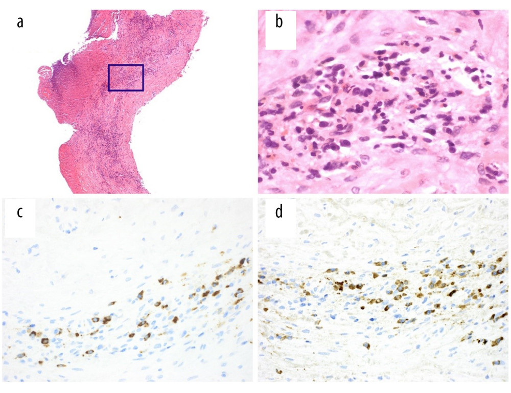 Histological and immunohistochemical findings from the common bile duct (CBD) biopsy on admission. (a) Bile duct biopsy of the CBD with hematoxylin and eosin (HE) staining shows marked chronic inflammation with low-power magnification (×10) and increased numbers of plasma cells (b) at higher magnification (×400). Immunohistochemistry reveals increased numbers of immunoglobulin (Ig) G4-positive plasma cells (c) relative to IgG-positive forms (d) (immunoperoxidase, ×200).