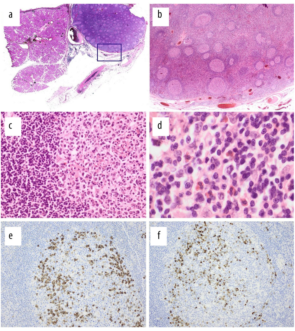 Retrospectively analyzed immunoglobulin (Ig) G4 preparations in chronological order: Submandibular gland (left) with lymph nodes (right) 7 years before the diagnosis of IgG4-RD. (a) Low-power magnification (HE, ×10) of the submandibular gland (left side) and enlarged cervical lymph node (right side) with (b) increased number of lymphoid follicles (HE, ×100). At higher magnification (c), the germinal centers have a monotonous appearance with loss of proliferation areas (HE, ×200) and (d) increased numbers of plasma cells and eosinophilic granulocytes (HE, ×400). Immunohistochemistry shows significantly increased numbers of IgG4-positive plasma cells (e) relative to IgG-positive forms (f) (immunoperoxidase, ×200).