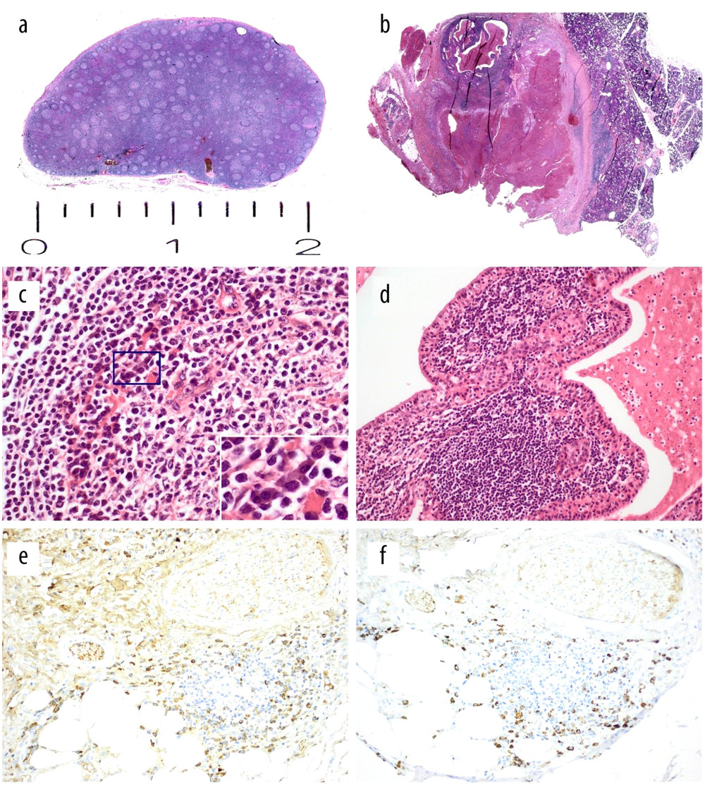 Parotid tumor and enlarged lymph nodes 13 months before the diagnosis of immunoglobulin (Ig) G4-related disease. Low-power magnification shows (a) an enlarged lymph node with increased numbers of lymphoid follicles and (b) the parotid gland with an encapsulated cystic tumor (HE, ×10). The lymphoid follicles (c) in the lymph node show increased numbers of plasma cells (inset), especially at the border between the germinal center and mantle zone (HE, ×200). (d) The parotid tumor was a so-called cystadenolymphoma (Warthin tumor), also with increased numbers of plasma cells (not shown) (HE, ×200). Immunohistochemistry again shows significantly increased numbers of IgG4-positive plasma cells (e) relative to IgG-positive forms (f) (immunoperoxidase, ×200).