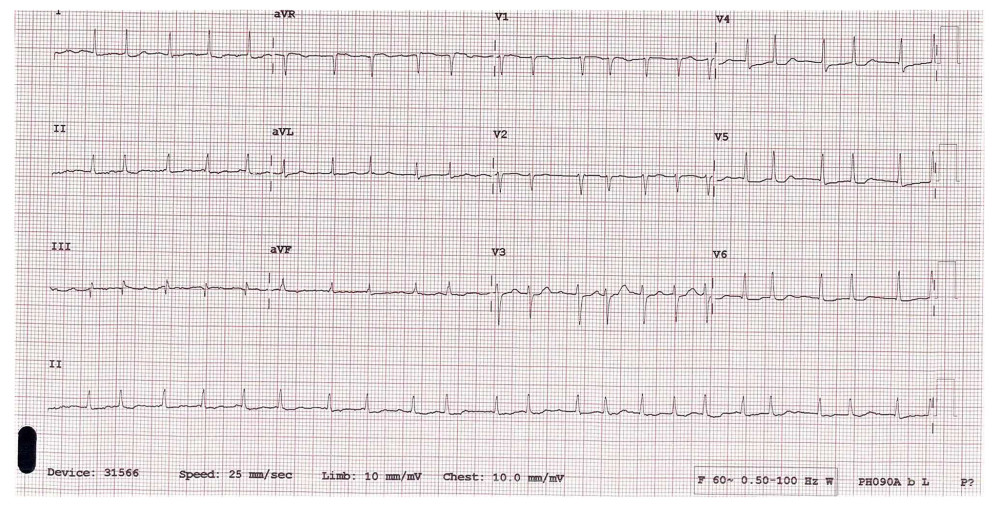 Twelve-lead surface electrocardiogram showing atrial fibrillation with a rapid ventricular response, estimated rate approximately 140 beats/minute, and no evidence of bundle branch block or ST-segment changes.