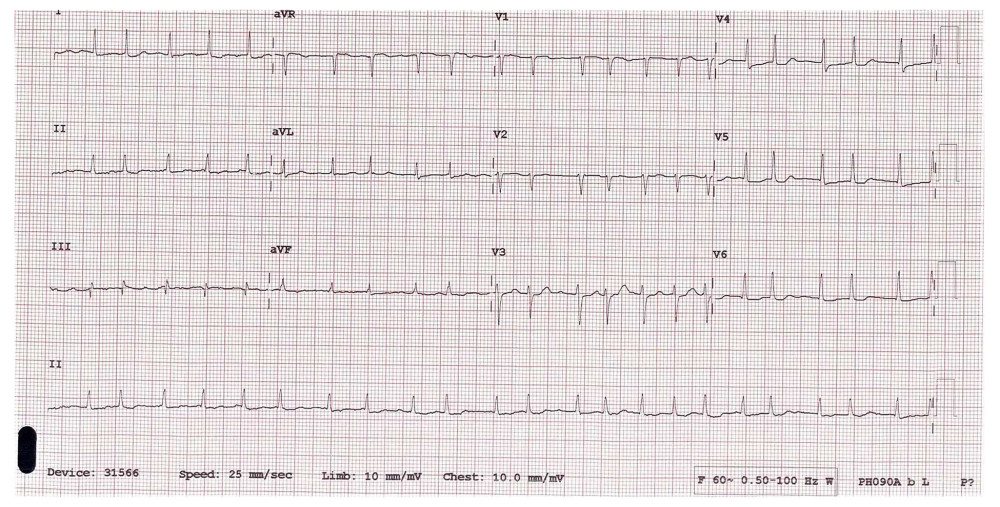 Twelve-lead surface electrocardiogram showing atrial fibrillation with a rapid ventricular response, estimated rate approximately 140 beats/minute, and no evidence of bundle branch block or ST-segment changes.