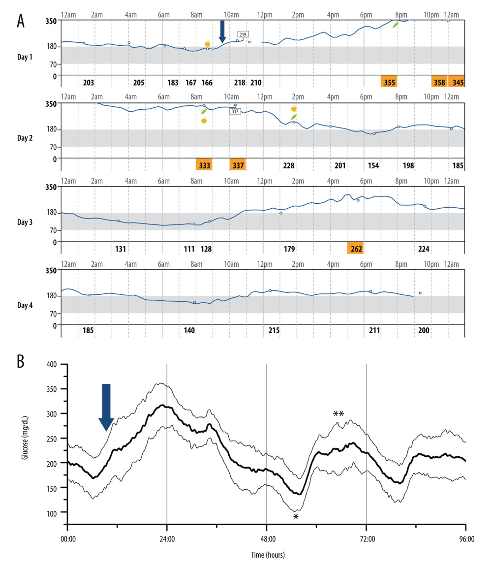 The triphasic glycemic pattern following chemotherapy which contained IV Dexamethasone (arrow). (A) Four days CGM showed a steady state of hyperglycemia reached within 3 h and lasting around 23-35 h, with no association to meal intake, followed by a transient BG improvement for 14–21 h, and ending with another hyperglycemic plateau of 7–13 h on day 3 after chemotherapy. (B) Average glucose tracing of CGM from 23 cycles showed the average glucose tracing and standard deviation. (* Normal/low glucose between 2 hyperglycemia phases; ** hyperglycemia plateau shape similar to the baseline.)