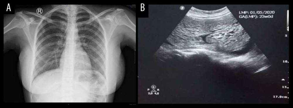 (A) Normal chest X-ray. (B) Abdominal ultrasound showing snowstorm appearance.