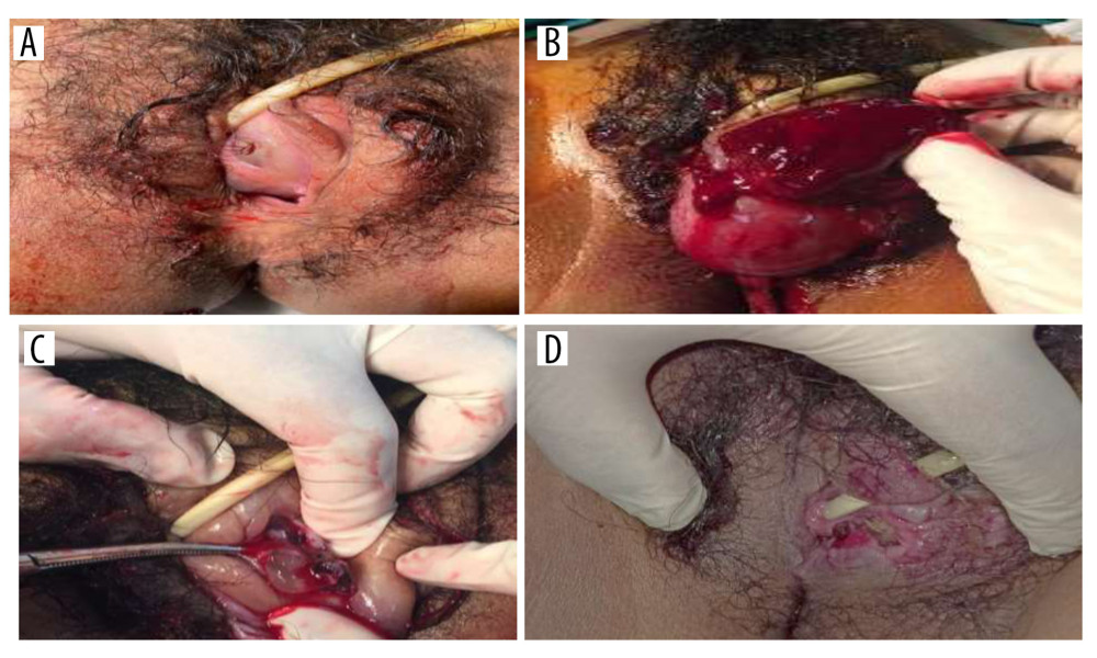 (A) The vaginal mass before perforation. (B) Incision and evacuation of the vaginal mass. (C) Presence of vesicular-like tissue inside the vaginal mass. (D) Appearance after evacuation of the vaginal mass.