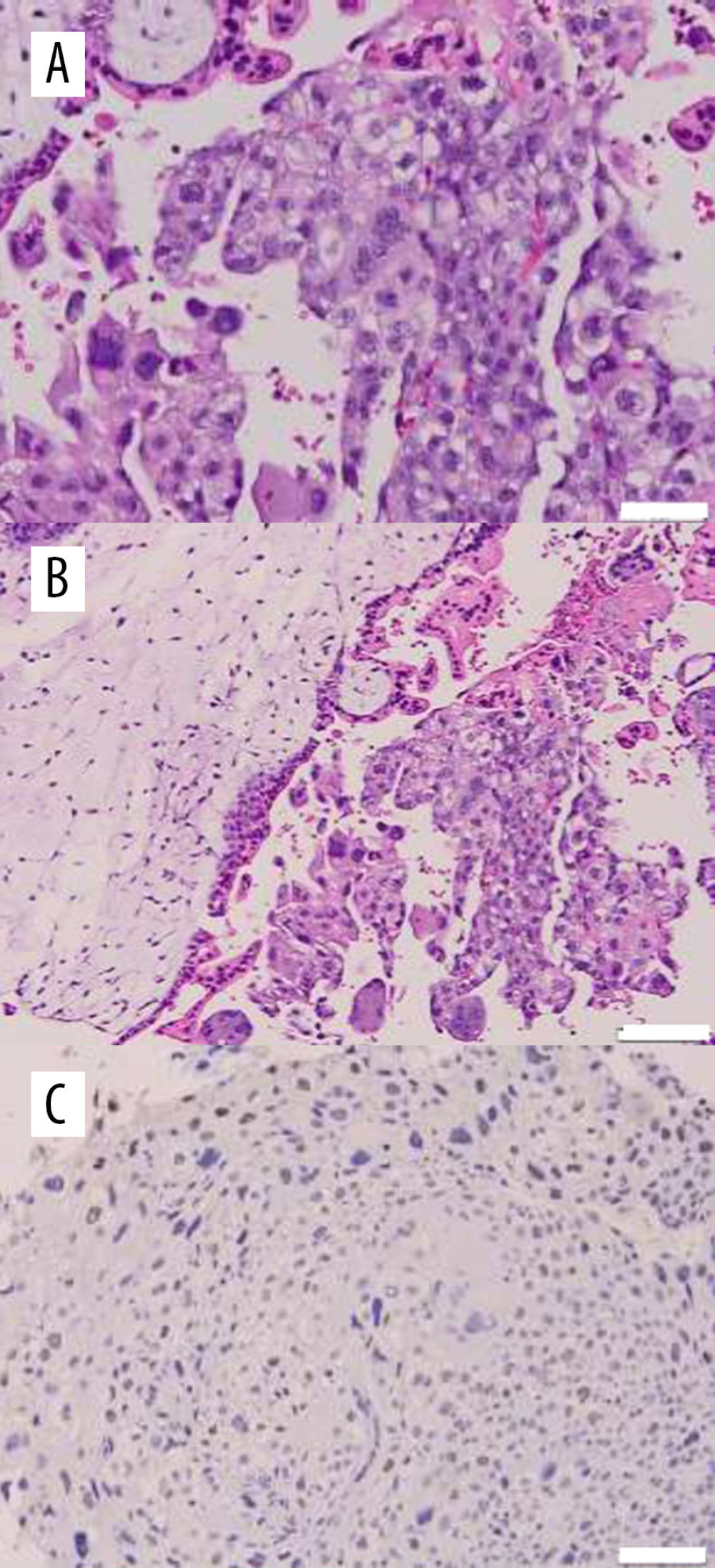 (A) Histopathologic reevaluation of the vaginal mass. (B) Histopathologic reevaluation of the uterine mass. (C) p53 immunohistochemistry of the molar mass. Scale bars=100 µm.