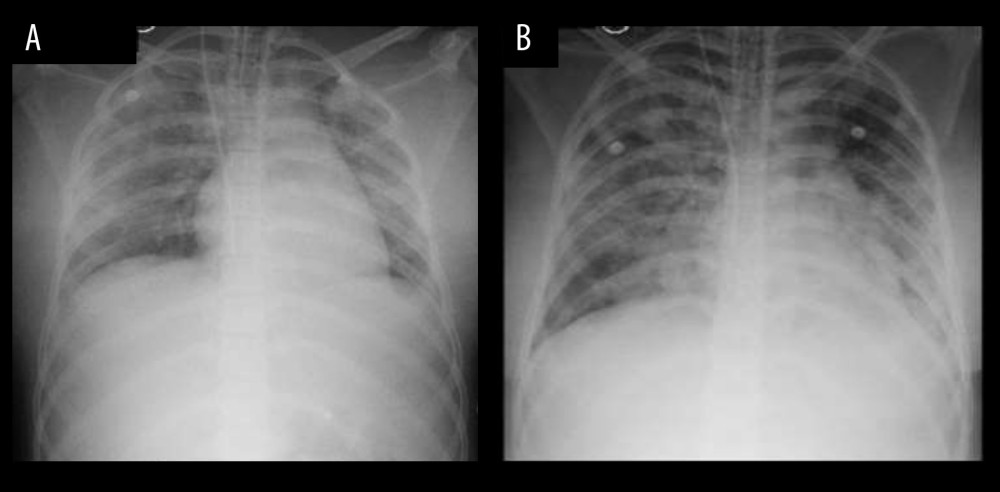 (A) X-ray taken on postoperative day 2 showing bilateral pneumonia. (B) X-ray taken on postoperative day 4 showing pulmonary edema.