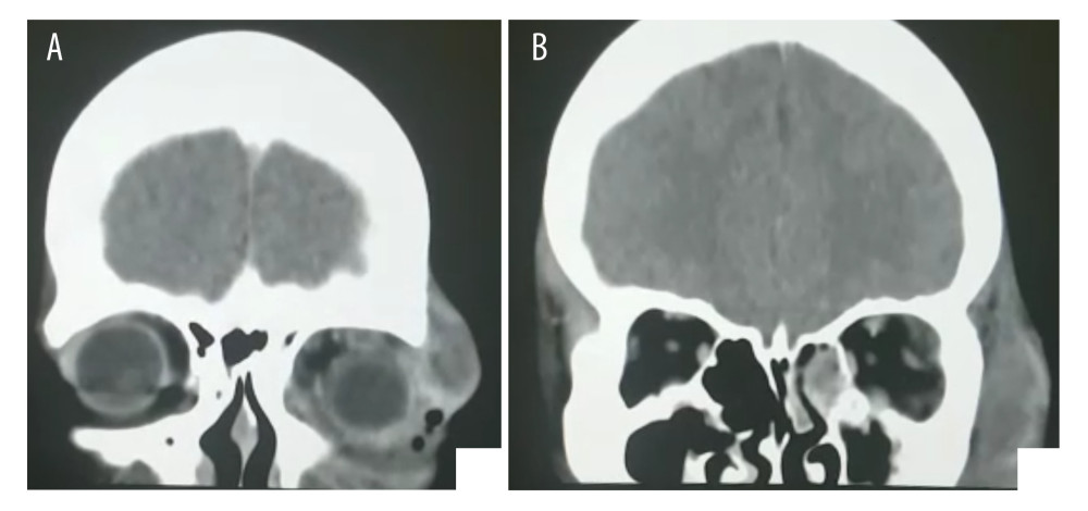 (A, B) Computed tomography: Coronal section showed rhinosinusitis with a periorbital abscess.