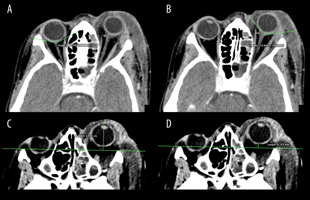 Computed tomography, axial sections: (A, B) Difference between the posterior angles of eyeballs (right: approx. 140º; left: approx. 117º). (C) Distance between the anterior sclera and the 27.7-mm interzygomatic line. (D) Ocular proptosis (4.2 mm).