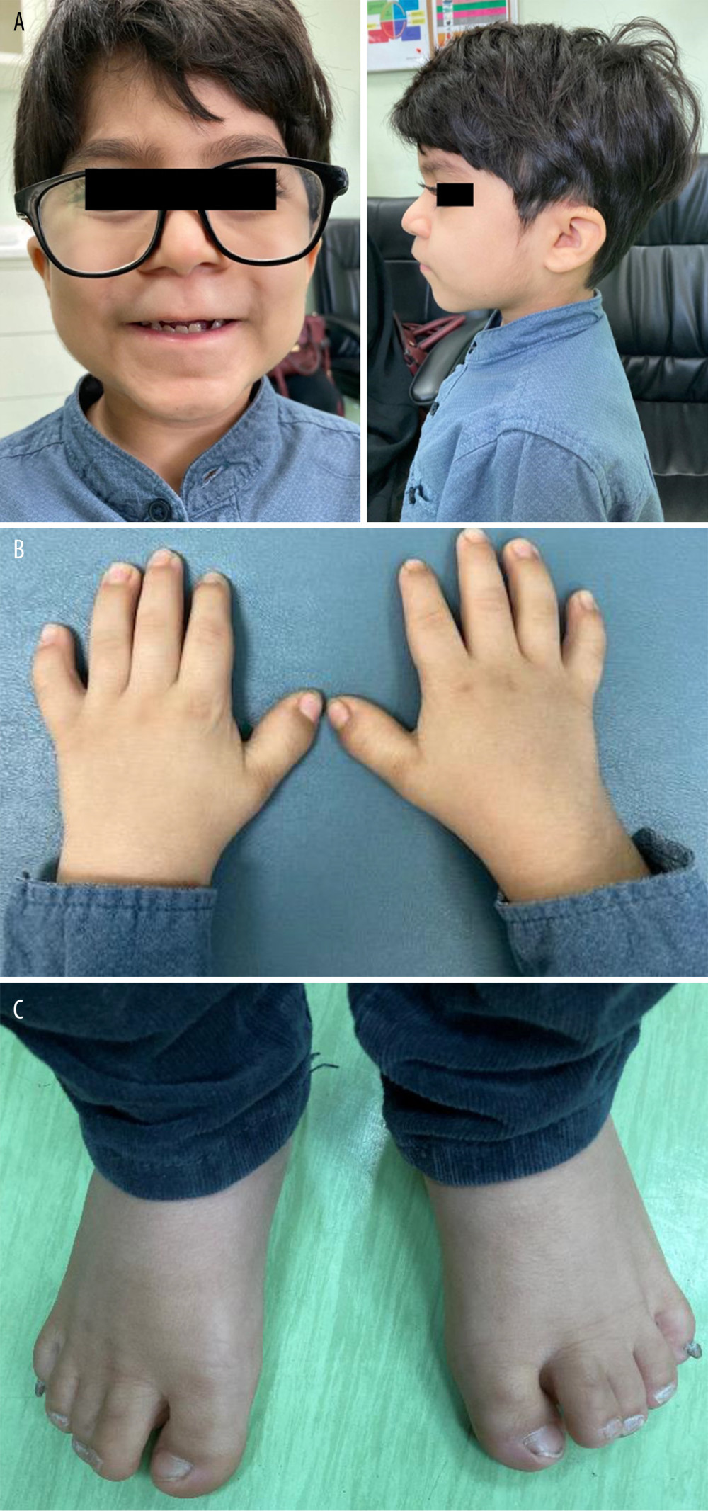 (A) Frontal and lateral photograph of the patient with WMS. (B) Photograph of the hand of the WMS patient showing short hands and stubby fingers (brachydactyly), as well as curvature of the fourth and little fingers (clinodactyly). (C) Photograph of the foot of the patient with WMS showing short toes and overlapping second and third toes. WMS – Weill-Marchesani syndrome.