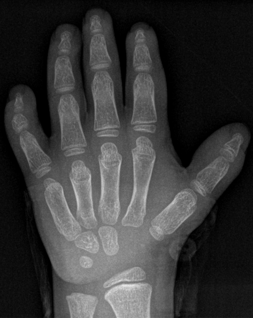 Frontal left-hand radiograph showing small middle phalanx of the little finger causing shortening and curvature of the little finger.