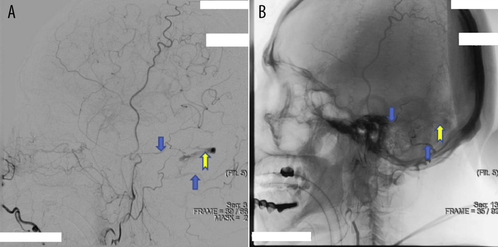 (A, B) The DSA images in case 1. The yellow arrows indicate the DAVF site, and the blue arrows indicate the feeding artery. The DAVF was supplied by the branches of the middle meningeal artery and occipital artery.