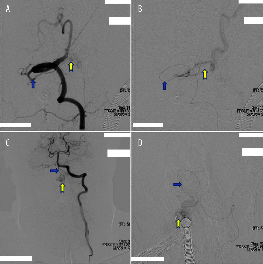 The DSA images in case 2. The DAVF was supplied by bilateral vertebral artery branches: the right (A, B) and left one (C, D). A and C were pre-embolization, but B and D were post-embolization. The yellow arrows indicate the DAVF site, and the blue arrows indicate the feeding artery.