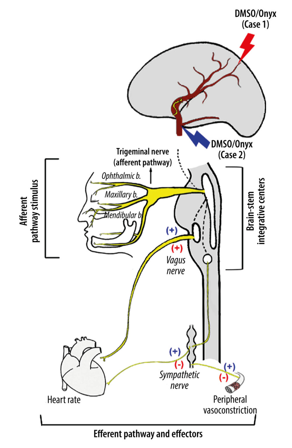 Schematic illustration of the autonomic neural pathways and effectors activated as a consequence of trigeminal nerve stimulation trigged either by peripheral signals from ophthalmic, maxillary, and mandibular branches or central cerebral vascular stimulus (figure modified from Buchholz’s publication [18]). The central TCR, which was stimulated by DMSO/ Onyx injection in the central vessel, induces a strong depressive response by a reciprocal activation of the parasympathetic system and an inhibition of the sympathetic system (red symbols). The peripheral TCR, which was stimulated by DMSO/Onyx injection in the peripheral vessels, involves simultaneous co-activation of both autonomic limbs (blue symbols).
