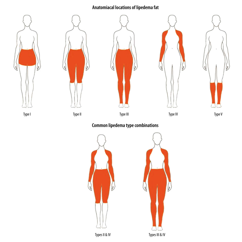 Anatomical Locations of Lipedema Fat. Lipedema fat may be located from the umbilicus down to the bottom of the hips (Type I), down to the medial knees usually including a pad of fat on the inner knee and below the knee (Type II), and down to the ankle (Type III) where a “cuff” of fat develops but spares the dorsal foot. Rarely are only the lower legs affected (Type V). Lipedema affecting the arms alone is rare (Type IV) and, instead, usually is found in combination with Type II or III lipedema. The arms can be variably affected with nodular lipedema fat around the cubit nodes, over the brachioradialis, down the medial arm to the wrist in line with the thumb or 5th digit, the entire lower arm, or the entire arm. With permission [28].