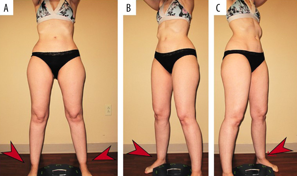 Case photos were taken after return to health with remission of anorexia nervosa and at the time of lipedema diagnosis. (A) Front of torso showing very thin upper body with ribs visible, with larger hips and thighs; arrows point to ankle cuffs. (B) Torso at 45 degrees; left arrow points to ankle cuff. (C) Torso at 45 degrees right. Notice even at a healthy weight, intercostal spaces are noticeable; arrow points to ankle cuff.