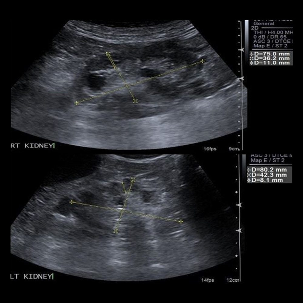 Renal ultrasound image of kidneys. Bilateral small-sized kidneys with increased parenchymal echogenicity (grade 2 in right and grade 3 in left) and lobulated contours are seen. The linear dimensions of the kidneys were as follows: longitudinal length of 75.0 mm (right) and 80.2 mm (left), cortical parenchymal thickness of 11.0 mm (right) and 8.1 mm (left). Numerous anechoic cystic formations were observed in the right kidney, the larger in the lower zone, 14×13 mm in size, parapelvic location, the larger in the left kidney, 16×13 mm in the upper zone, cortical, and exophytic extension.