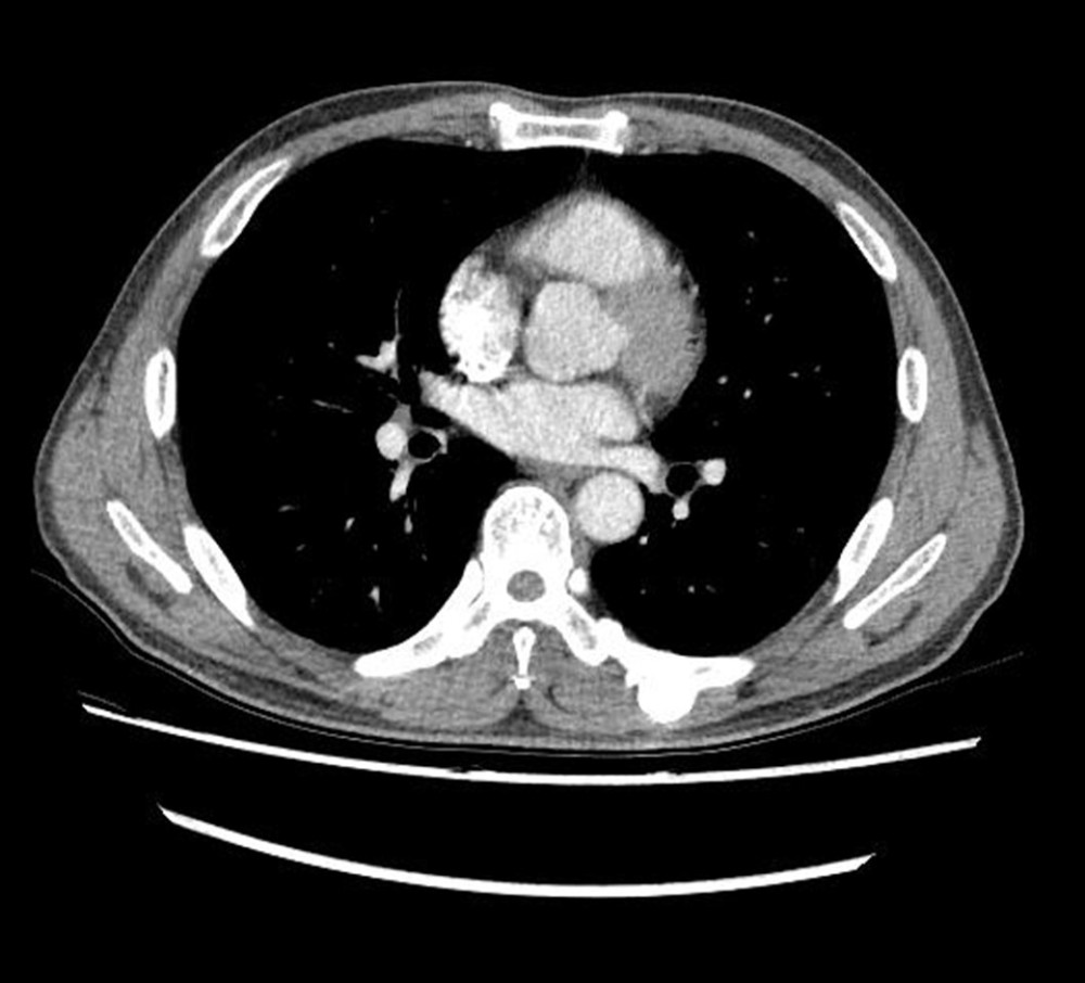 A computed tomography scan shows that the mass arises from the posterior costal arc of the eighth rib on the patient’s left side and does not involve the medulla.