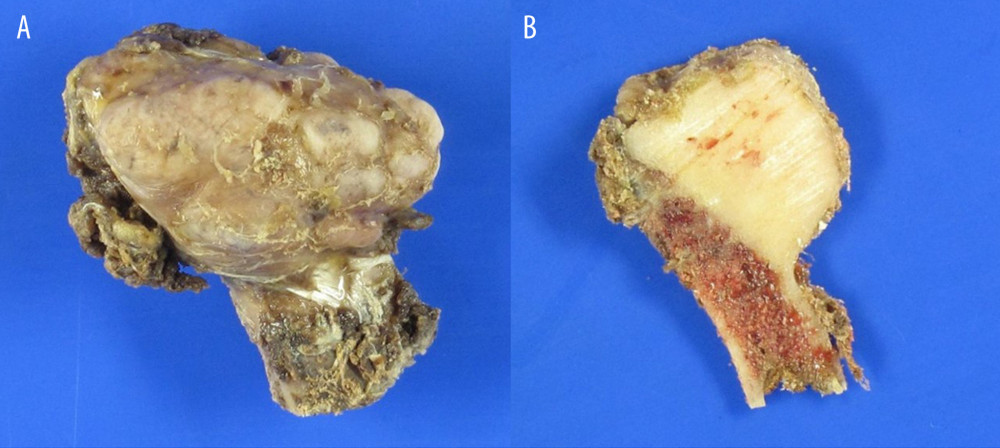 (A) Gross examination shows that the bony mass, which measured 2.5 cm, has a lobulated contour. The external surface is smooth and covered by a thin, fibrous, soft tissue membrane. (B) The mass is yellow or ivory in color and has a hard consistency, making it blend into the cortex of the rib bone.