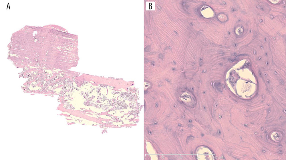 (A) A histologic section of the resected specimen shows that the solid mass was not connected to the marrow of the rib (hematoxylin and eosin [H&E], magnification×1). (B) The specimen is composed of compact, mature, lamellar bone with well-developed Haversian canals. (H&E, magnification×200).
