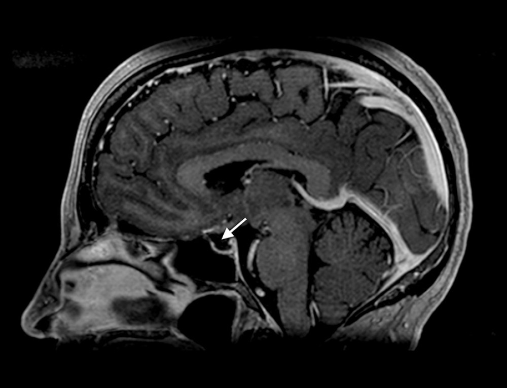 Magnetic resonance imaging brain scan showing empty sella (arrow)