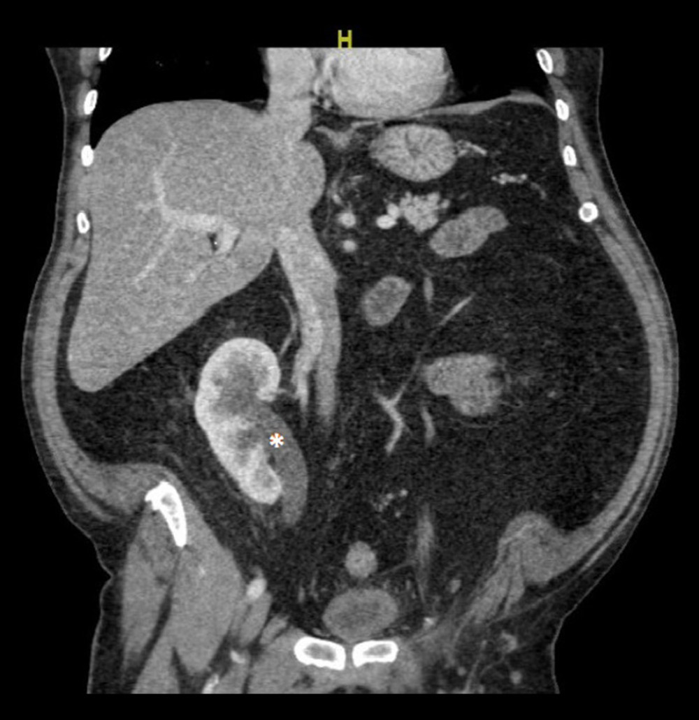 Coronal computed tomography scan of the abdomen and pelvis of a 67-year-old man with a ureteroinguinal hernia as well as right renal ptosis and hydronephrosis. The renal ptosis is apparent from the low-lying kidney seen in the image. The hydronephrosis is marked with an asterisk.