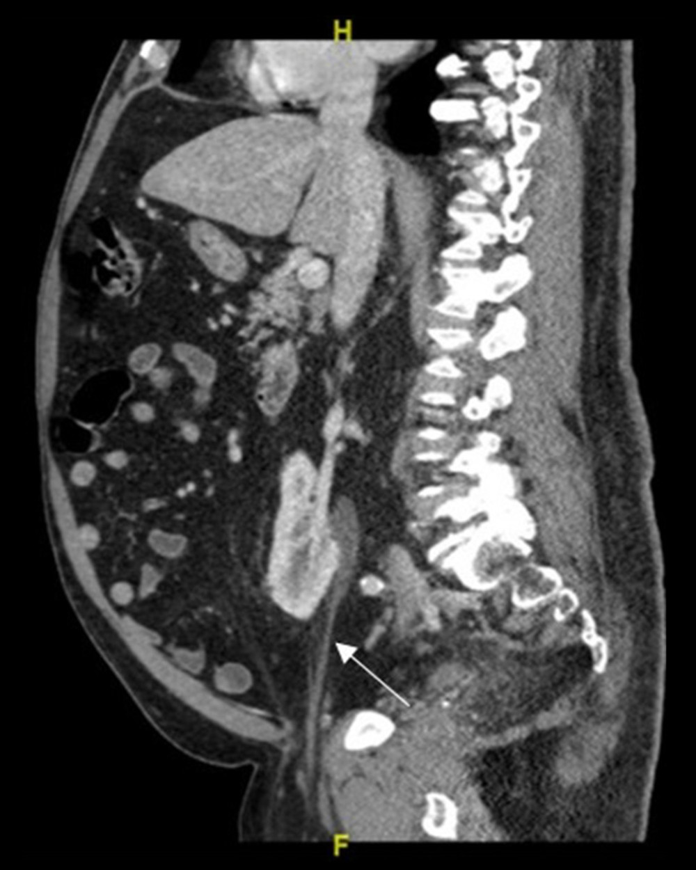 Sagittal computed tomography scan of the abdomen and pelvis in a 67-year-old man with ureteroinguinal hernia as well as right renal ptosis and hydronephrosis. The right ureter descending into a right inguinal hernia is visible in the image (arrow).