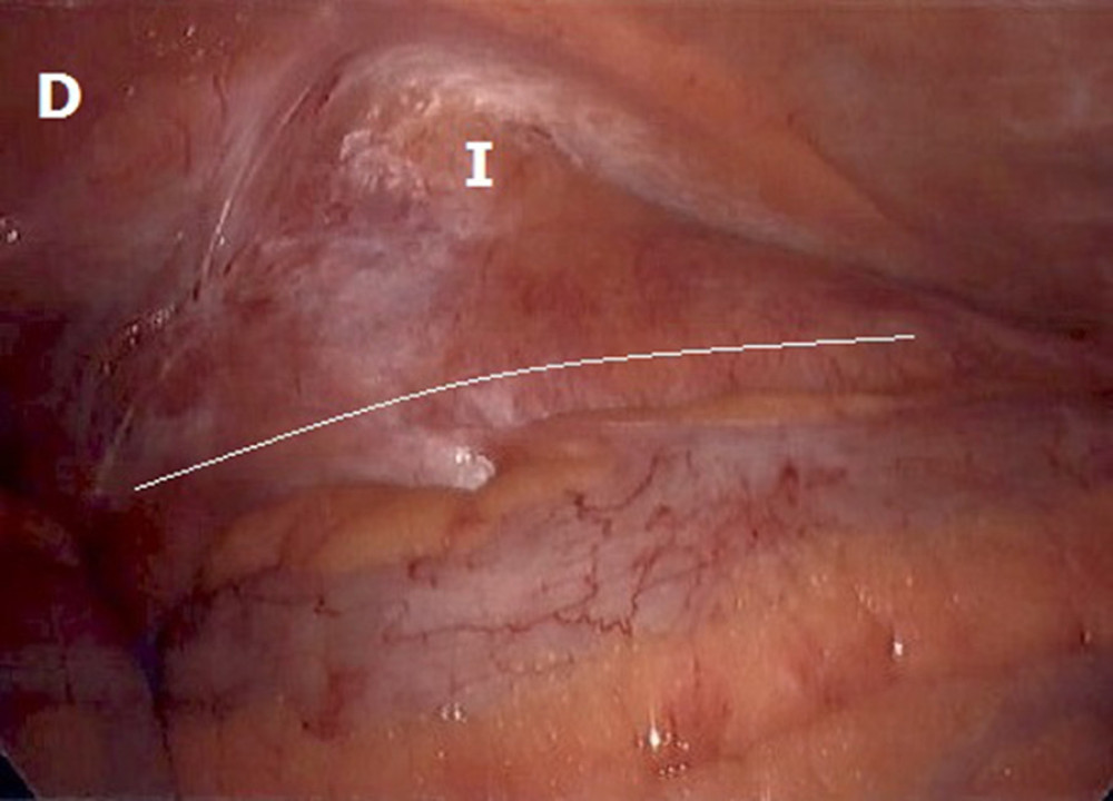 A laparoscopic image of the right peritoneum adjacent to the inguinal ligament (white line). Imaging demonstrated no peritoneal defect in the location where an indirect (I) or direct (D) hernia would be identified. No ureter was seen on laparoscopic evaluation. This lack of defect demonstrates evidence of an extraperitoneal ureteroinguinal hernia.