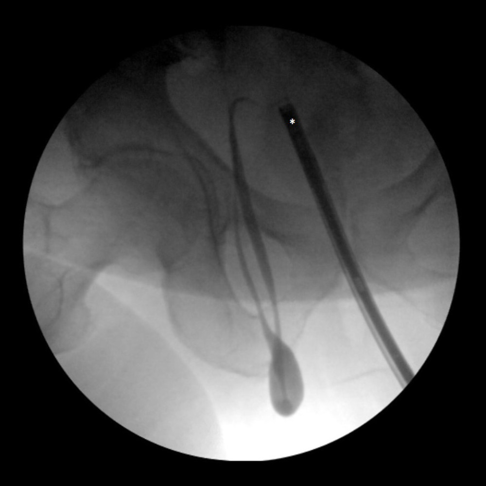 The retrograde pyelogram shows the typical “curlicue” or “loop-the-loop” sign associated with a ureteroinguinal hernia in a 67-year-old man who presented with urinary symptoms and right inguinal hernia. A ureteral catheter is located in the distal ureter marked by an asterisk. Contrast leaving the catheter initially ascended into the abdomen before making a sharp turn and descending into the patient’s scrotum, where it made a loop and then ascended into the abdomen.