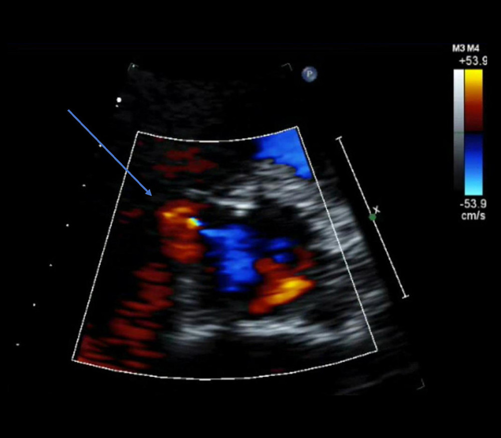 Parasternal short-axis view at the level of the aortic valve and right ventricular outflow tract (zoomed in view). Color Doppler overlying the aortic valve revealing no evidence of shunting. The arrow indicates a presumed sinus of Valsalva aneurysm involving the right coronary artery, measuring around 1.5 cm, which was confirmed to be a membranous ventricular septal aneurysm, as noted on CTA of the coronary arteries.