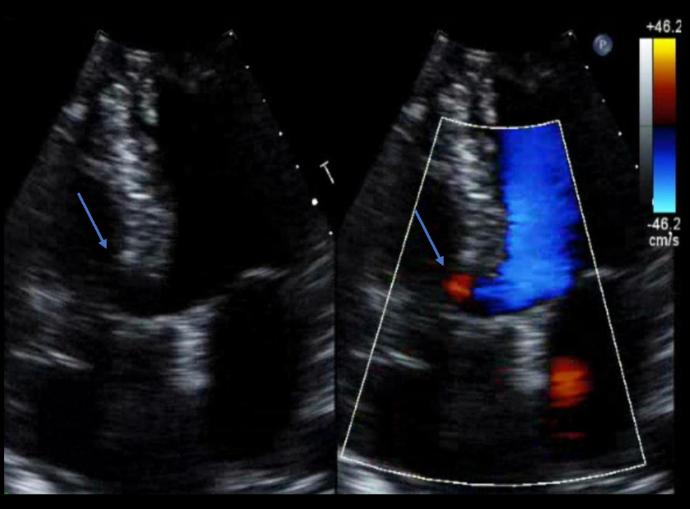 Apical 4-chamber view. Color Doppler overlying the presumed sinus of Valsalva aneurysm revealed no evidence of shunting. The arrow indicates the presumed sinus of Valsalva aneurysm involving the right coronary artery, measuring around 1.5 cm, which was confirmed to be a membranous ventricular septal aneurysm, as noted on CTA of the coronary arteries.