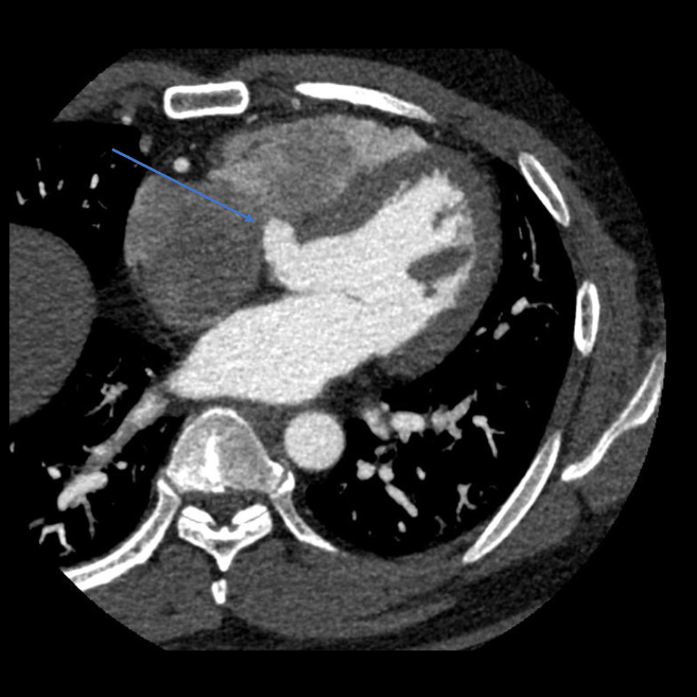 Axial view. 180° left anterior oblique and 90° caudal view. The arrow indicates a membranous ventricular septal aneurysm measuring 13×17 mm, without no evidence of shunting.
