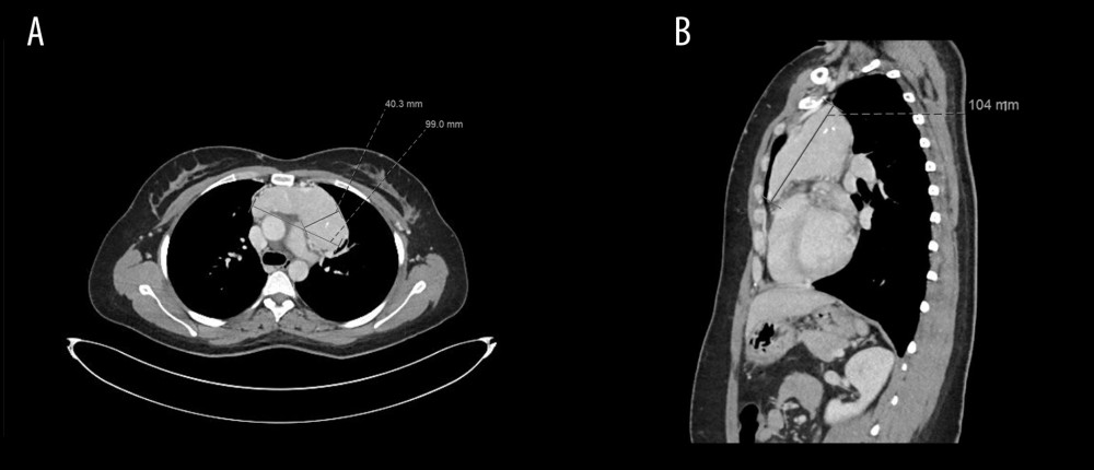 Computed tomography scans of an anterior mediastinal mass that measured 10×4×10.4 cm. (A) Coronal view. (B) Sagittal view.