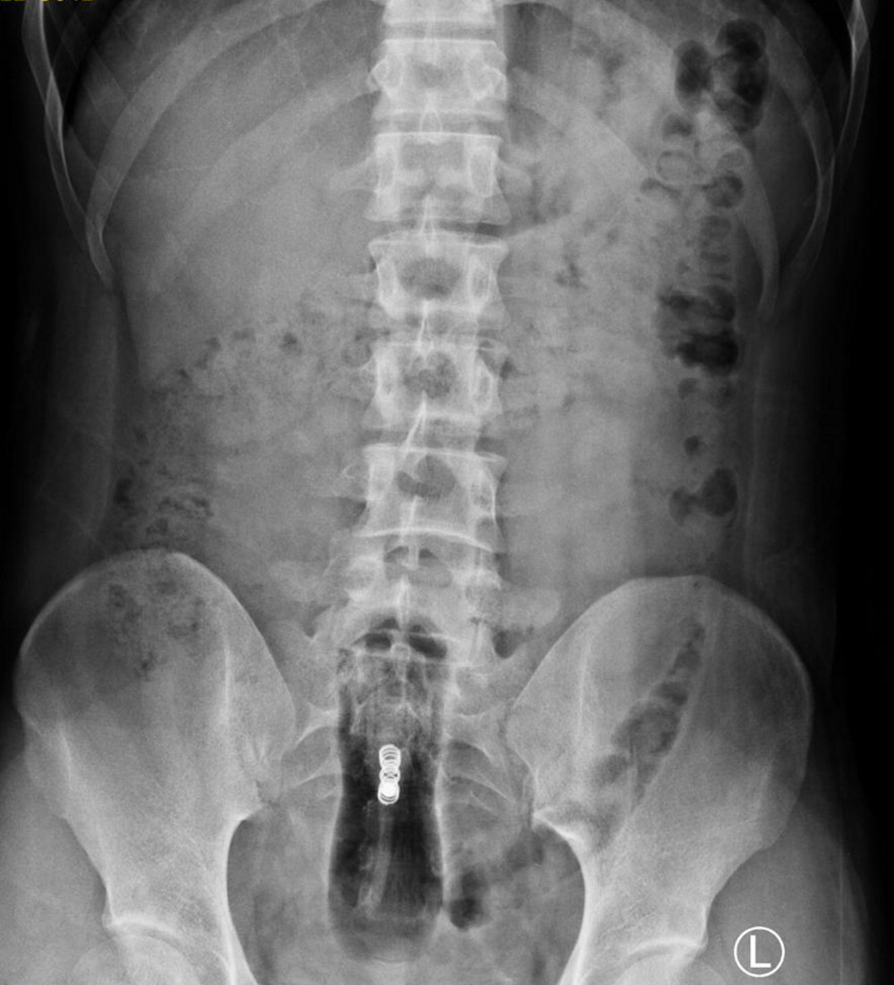 Pelvic radiograph revealed a well-defined radiolucent foreign body in the pelvic region.