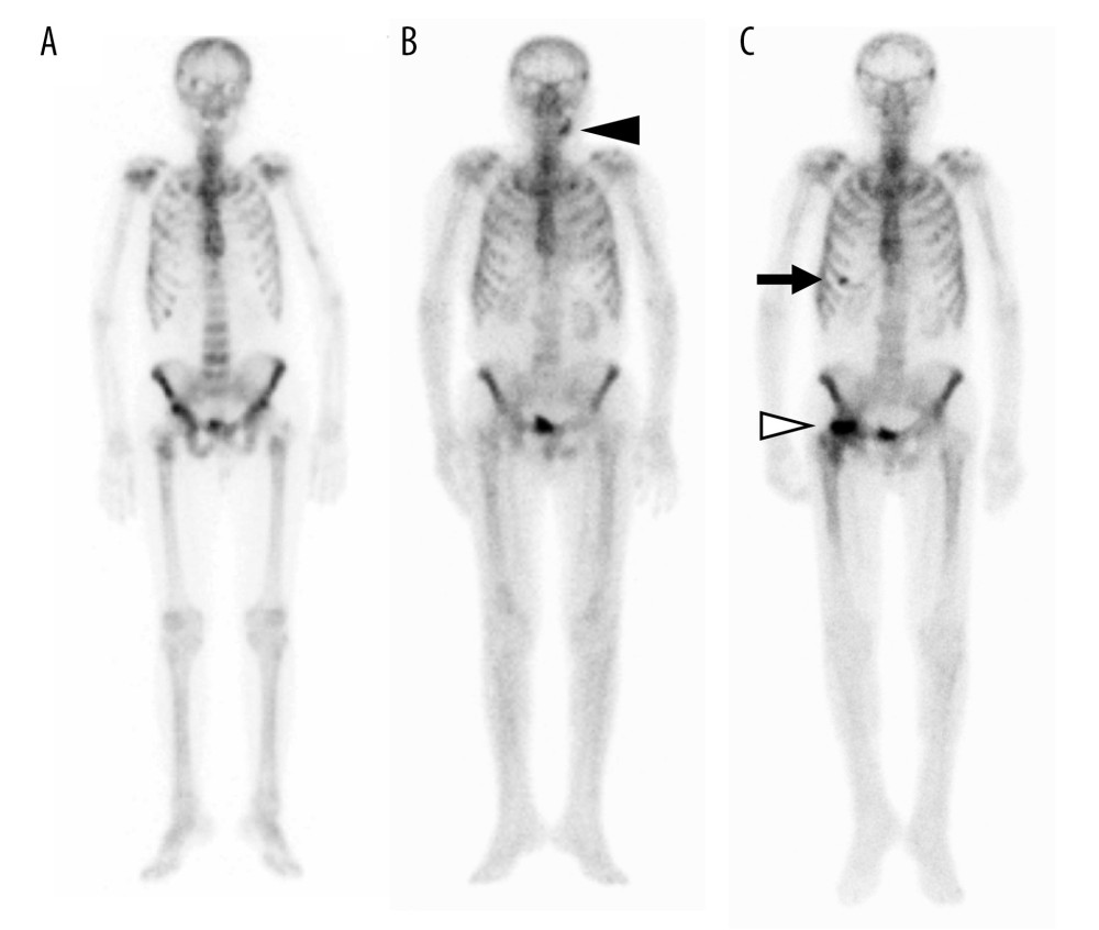 Status of bone metastasis by scintigraphy. (A) Multiple metastases to ribs, vertebrae and pelvic bone at the time of prostate cancer diagnosis. (B) Jaw osteonecrosis (black arrowhead) induced by denosumab occurring after the 26th cycle of cabazitaxel. (C) Abnormal uptake in the right femoral head (white arrowhead) and right sixth rib (black arrow) caused by idiopathic femoral head necrosis and traumatic rib injury after the 52nd cycle of cabazitaxel.
