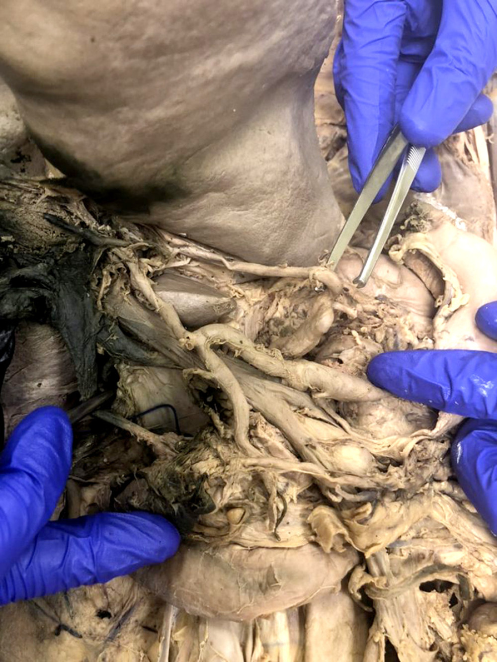 The three anomalous hepatic arteries can be seen branching directly off the the celiac trunk and inserting into the liver in this photograph. In this view, the portal vein and biliary tree are present to highlight the anomalous vasculature relative to local anatomic structures.
