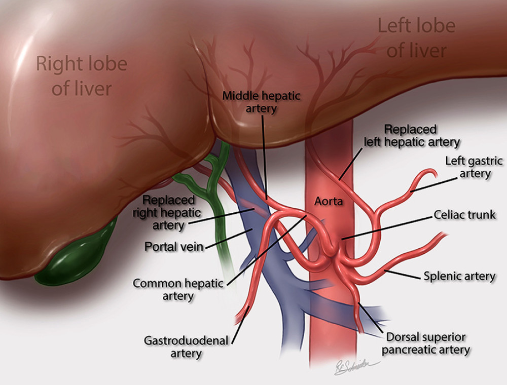 Illustration depicting the vascular anomalies.