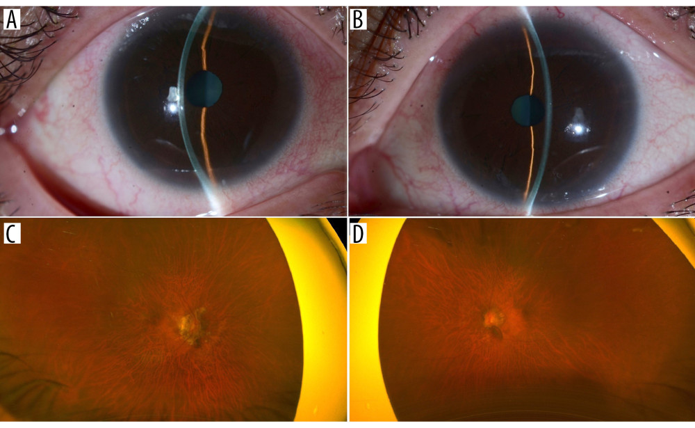 (A, B) Slit lamp images showing a moderately deep anterior chamber centrally and shallow anterior chamber peripherally in the (A) right and (B) left eye. (C, D) Wide-field Optos images showing a highly myopic fundus associated with tilted disc and peripapillary atrophy without obvious glaucomatous optic neuropathy in the (C) right and (D) left eye.