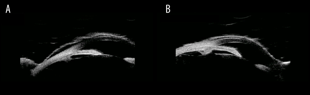 Ultrasound biomicroscopy images showing anterior bowing of peripheral iris closing the iridocorneal angle in the (A) right and (sB) left eye.