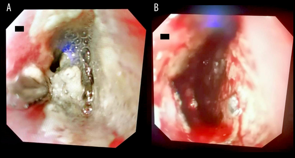 Endoscpic view of esophageal injury before (A) (shows circumferential exudate and battery in place) and after (B) removal of button battery (shows circumferential deep ulceration, necrosis, and hemorrhage).