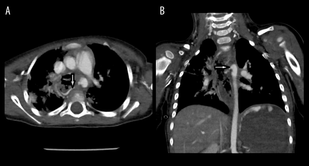 (A) Axial CT scan of the chest showing focal irregularity and bulging of the medial sidea orta with the fistula communication between the aorta and dilated esophagus (shown by the arrow). Also there is fistula between the esophagus and the right main bronchus. (B) Coronal view with contrast showing focal aortoesophageal fistula with contrast extravasation from the aorta into dilated esophagus. Also, there is contrast outlining the stomach wall reaching from the aortoesophageal fistula, indicating significant bleeding at time of presentation.