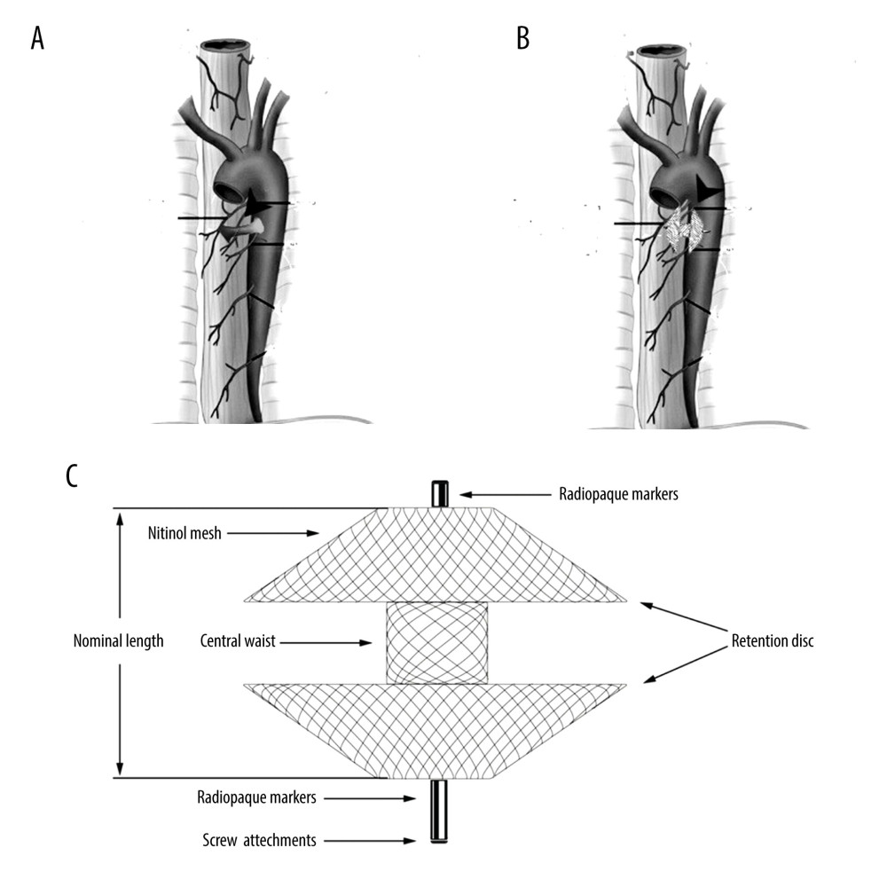 Procedure illustrations of vascular plug device. AEF, Aortoesophageal fistula (A, arrowhead), position of the device after placement (B, arrowhead), dimension and shape of the Amplatzer Duct Occluder II (C).