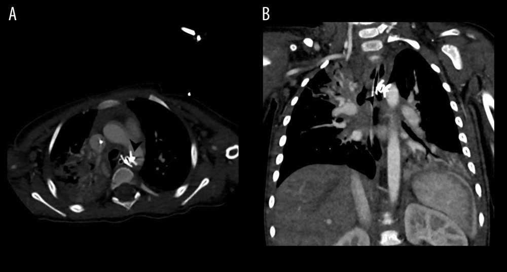 Axial (A) and coronal (B) CT scan of the chest post insertion of the vascular plug device (black arrowhead) through the aortoesophageal fistula securing both sides of the fistula.
