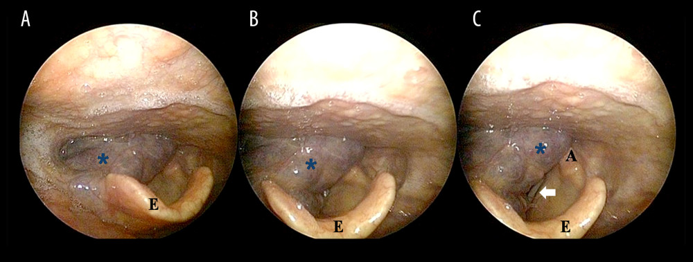 Representative preoperative laryngoscopic image. (A, B) A lobulated bluish mass (asterisk) was detected in the hypopharynx and larynx on the right side. (C) The left true vocal fold (white arrow) was partially observed to have an intact mucosa and a narrowed glottic space on abduction. A – arytenoid; E – epiglottis.
