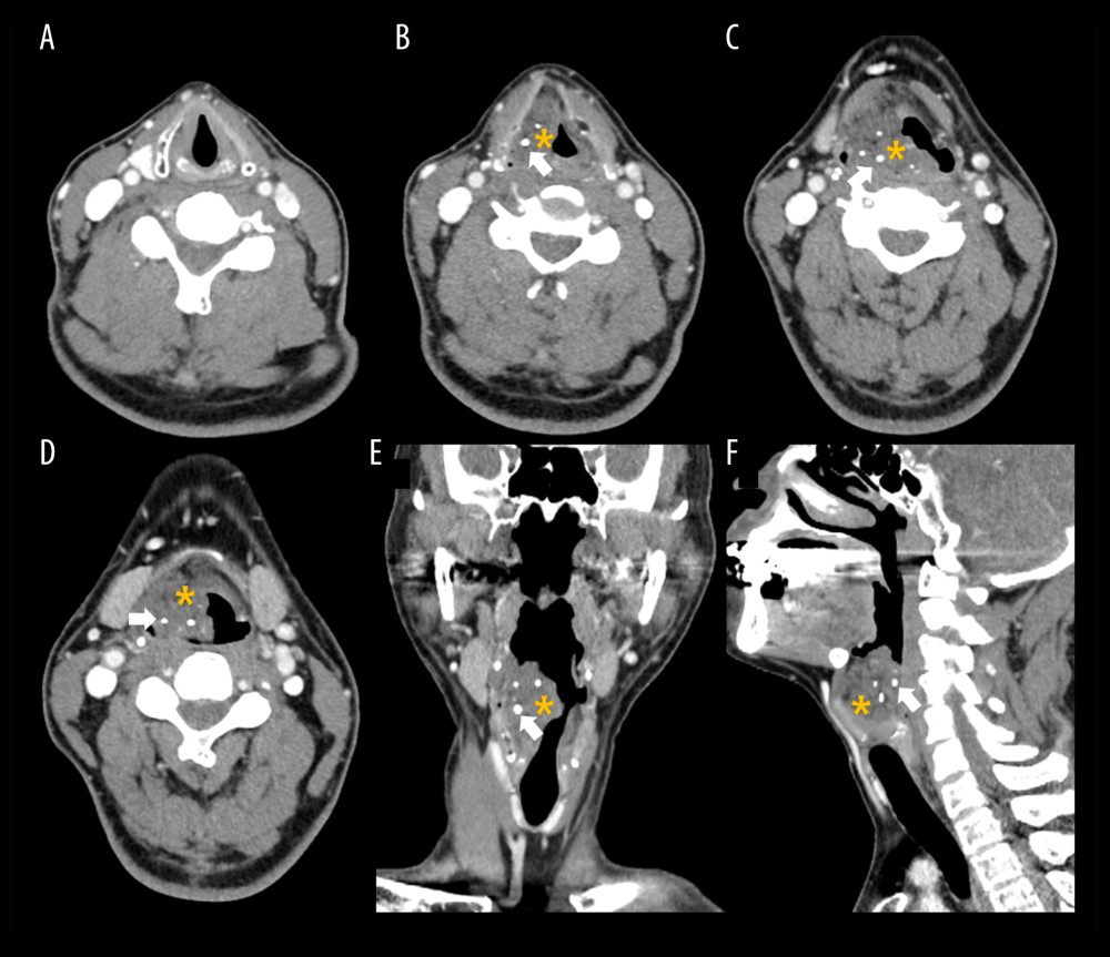 Representative preoperative computed tomography (CT) of the neck with contrast enhancement. (A) The true vocal fold and subglottis were not involved by the tumor (axial image). A 38×22×32-mm irregular lobulated soft tissue density mass (asterisk) with multiple calcifications (white arrow, phleboliths) was detected on an axial image (B–D), coronal image (E), and sagittal image (F).